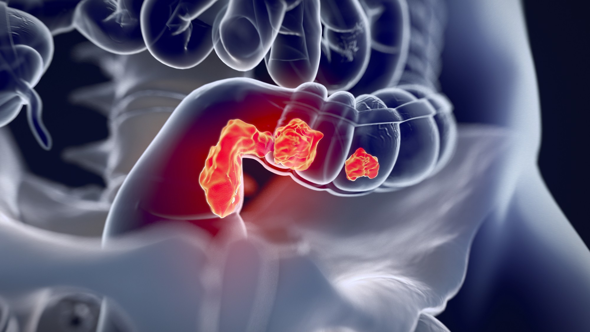 Colorectal cancer,medical illustration.3d illustration Imagem Coloproctologia